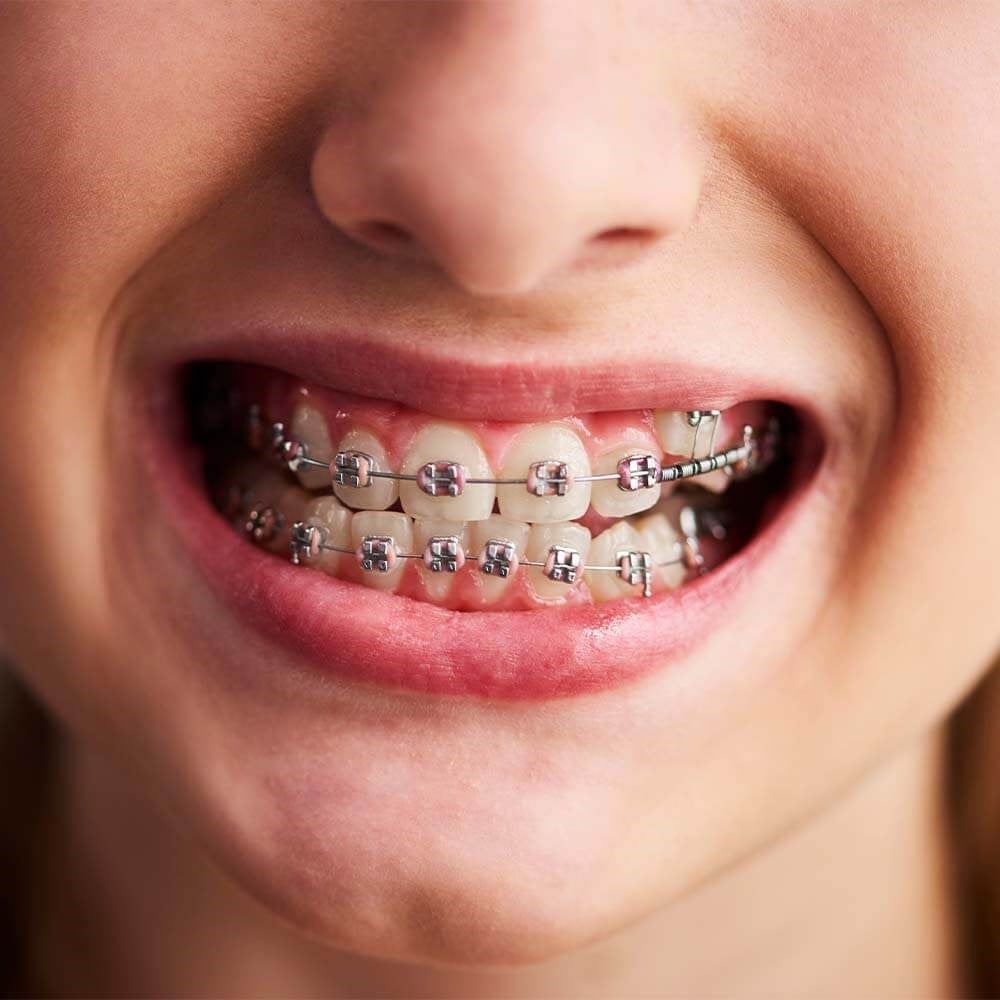 Mouth with Braces